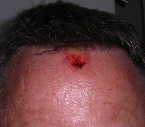 BloodyForehead-s1.jpg