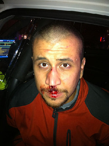 George_Zimmerman_front_of_head.jpg
